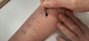 Allergie: che cos'è il prick test