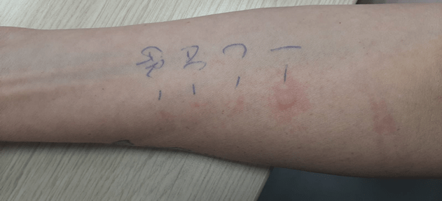 Allergie: reazione al prick test che cos'è